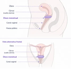 posición disco menstrual