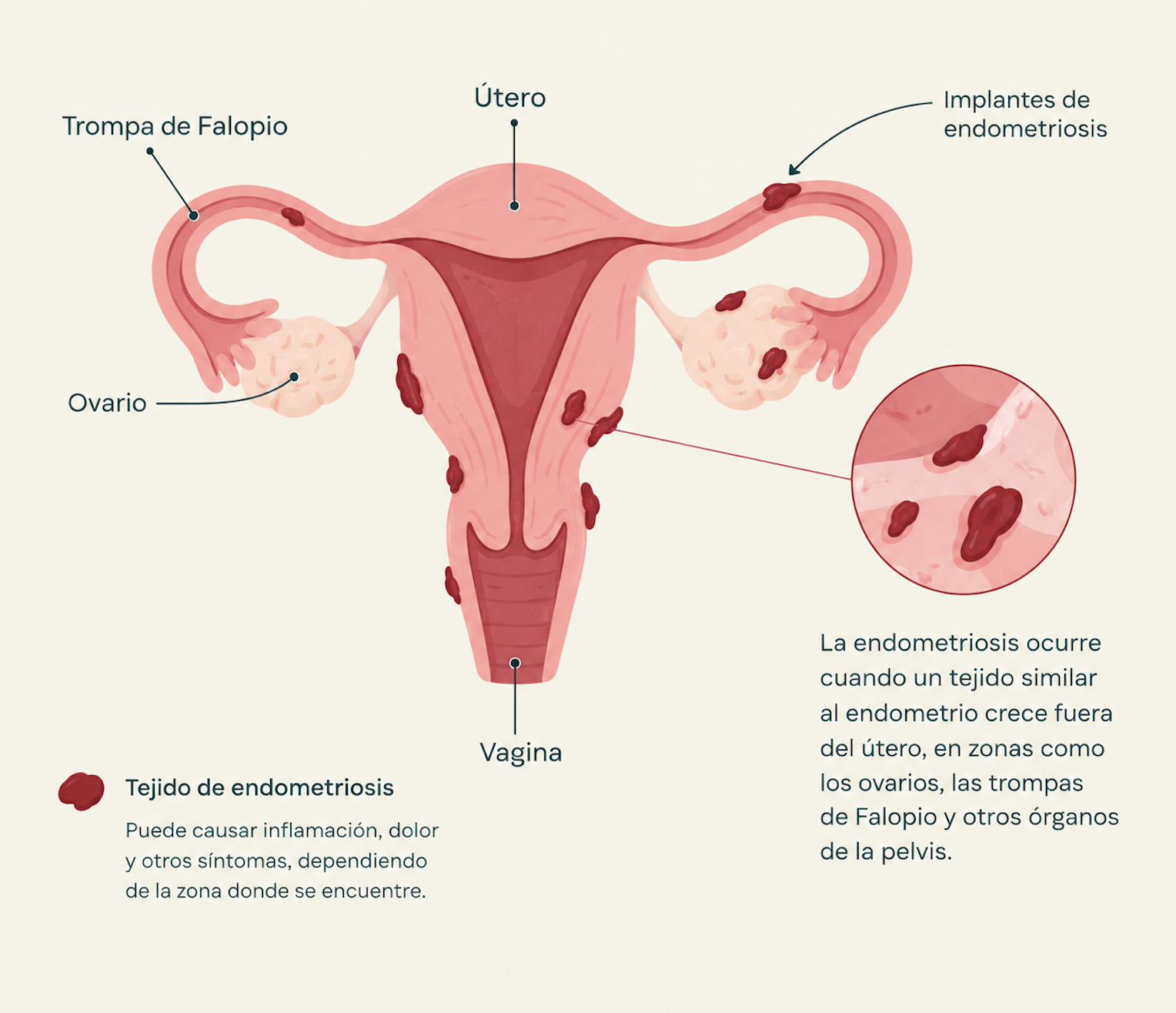 endometriosis