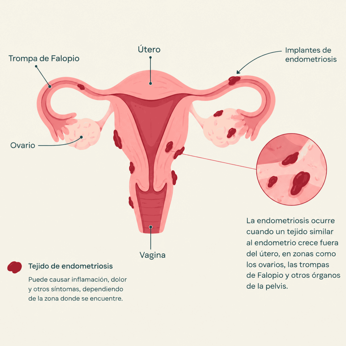 Ilustración del útero y tejido de endometriosis fuera del útero